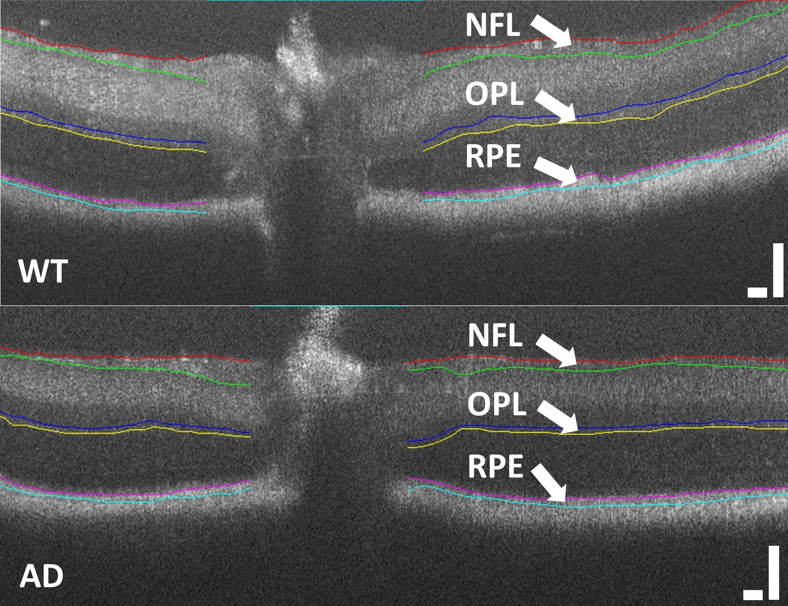 combined retinal layers